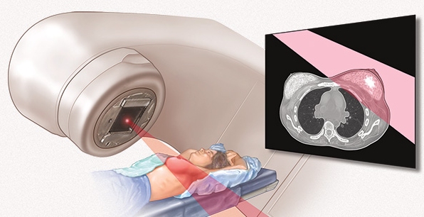 Radiation-Therapy-Machine-Picture